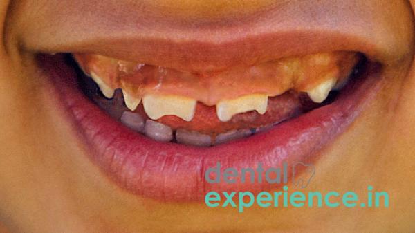 Malformed teeth